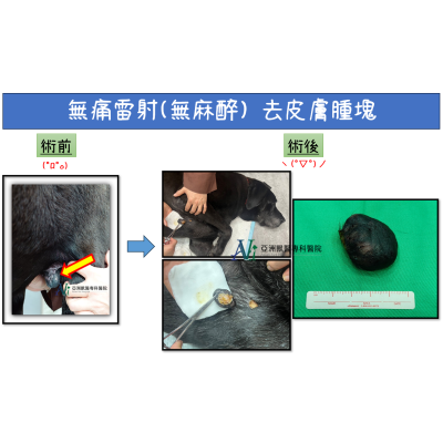 1/10 無痛雷射去疣 1/10 無痛雷射去疣