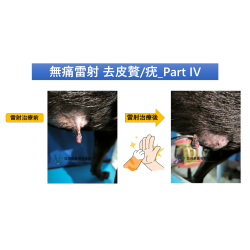 5/15 病歷分享-無痛雷射 去皮贅/疣_Part IV 5/15 病歷分享-無痛雷射 去皮贅/疣_Part IV